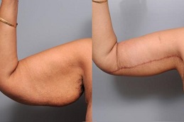Best Clinic of Arm Lift Surgery in Dubai