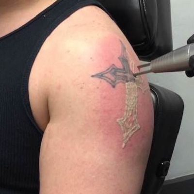 Picosure Tattoo Removal in Dubai & Abu Dhabi
