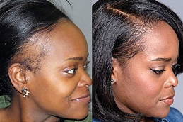 Best Clinic of Hair Restoration Dubai