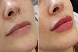 Best Clinic of Lip Fillers Injections Dubai