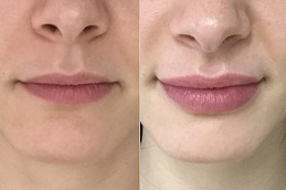 Best Clinic of Lip Fillers Injections In Dubai