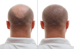 Best Hair Restoration Clinic in Dubai