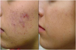 Acne Scar Treatment Cost in Dubai