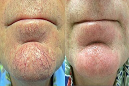 Best Facial Capillaries Treatment Cost in Dubai