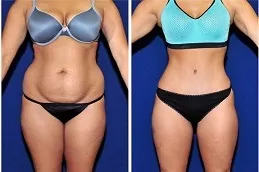 Best Fat Melting Injections Cost Dubai