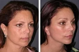 Results of MESOGOLD Stamp Therapy in Dubai:
With the treatment, the candidates gain outcomes in the form of young skin without wrinkles and lines. The face looks fresh and bright. The products that your clinic used and the expertise of your doctor play a significant role in determining the final effects of the method. Mostly, the outcomes gets appear after 3 to 4 days. 