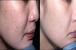 Best Pimples Treatment Cost