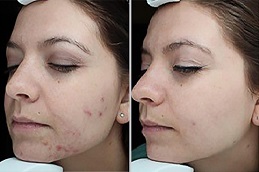 Pimples Treatment Dubai