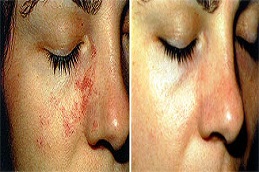 Birthmarks Removal Treatment Cost
