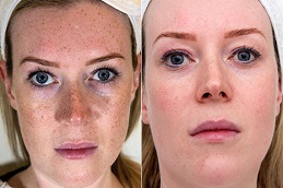 Chemical Peels Before and After