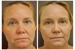 Fractional CO2 Laser Treatment Cost In Dubai