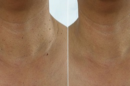 Skin Tag Removal Cost in Dubai