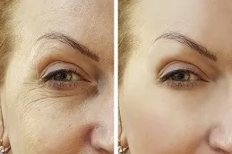 Botox Injections For Wrinkles Dubai