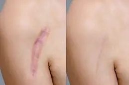 Post-Surgical Scars Dubai